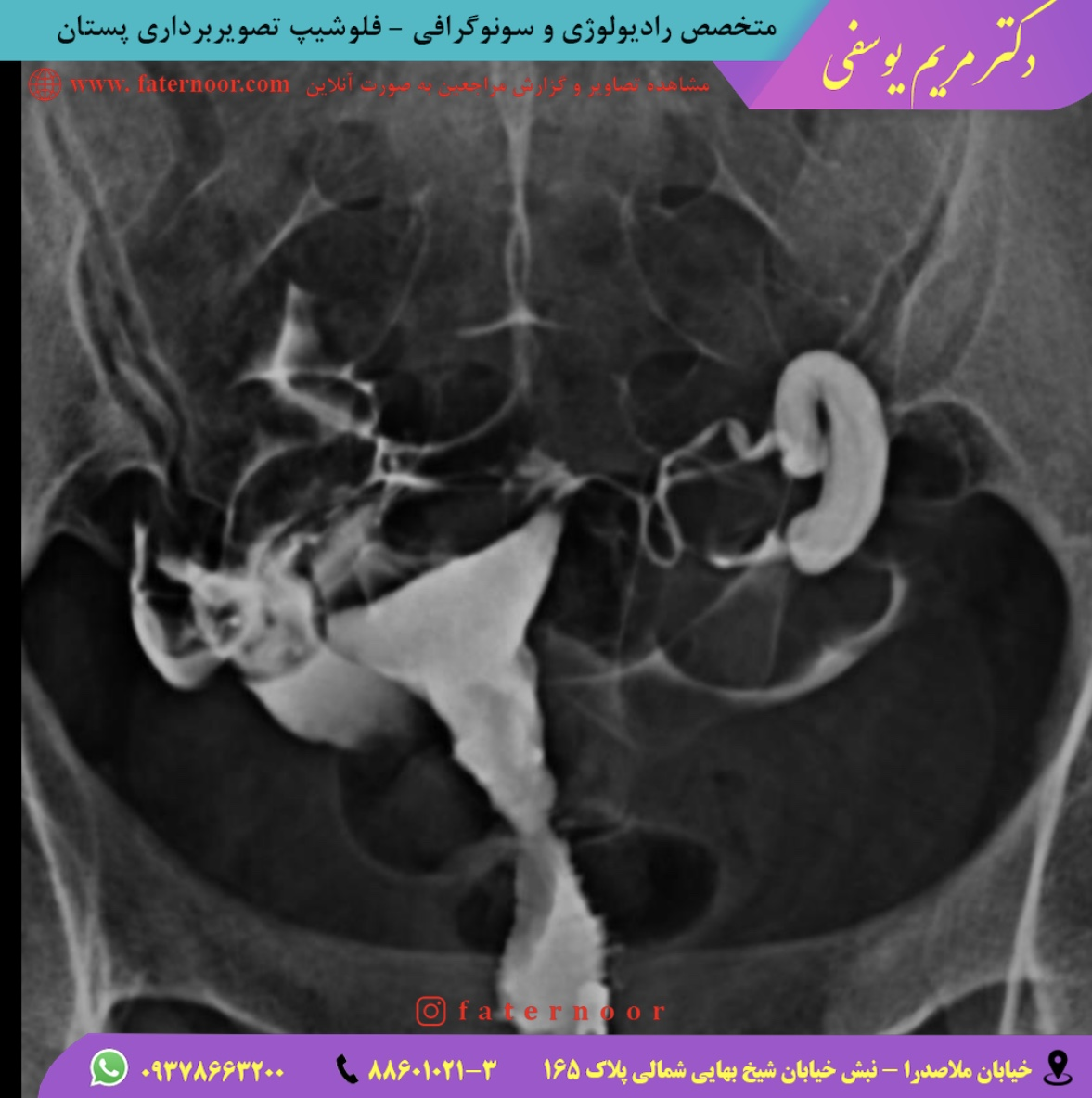 هیستروسالپنگوگرافی